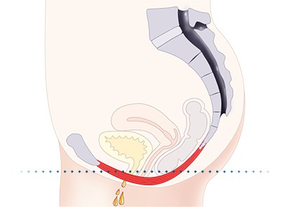 Pelvic-Floor Muscle Repair 5 Pelvic floor muscles Matlock