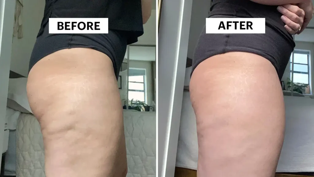 Do Toning Exercise Matlock Really Tackle Cellulite?