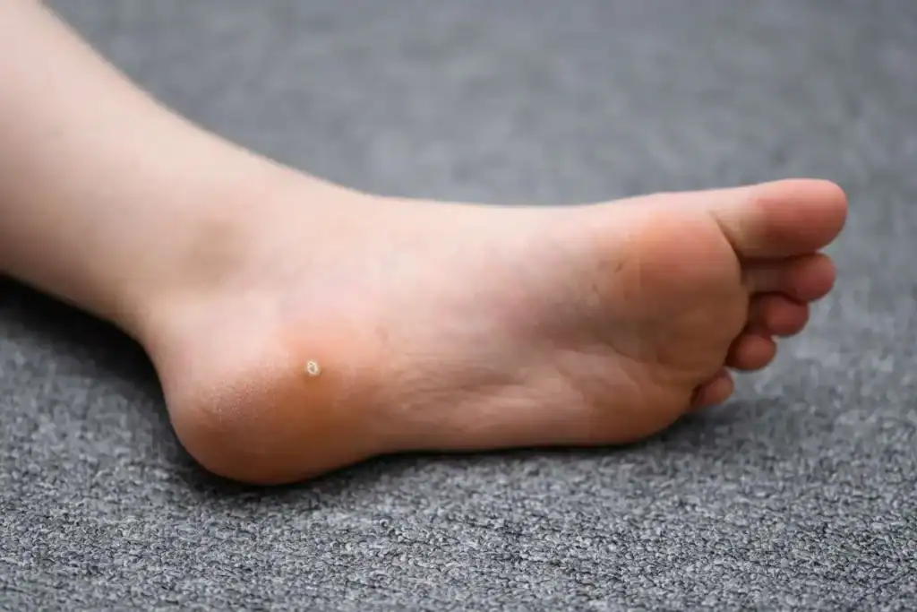 Cryotherapy For Warts And Also Verrucas 2 Image of verruca on the bottom of the foot that able to be treated with Cryotherapy Matlock
