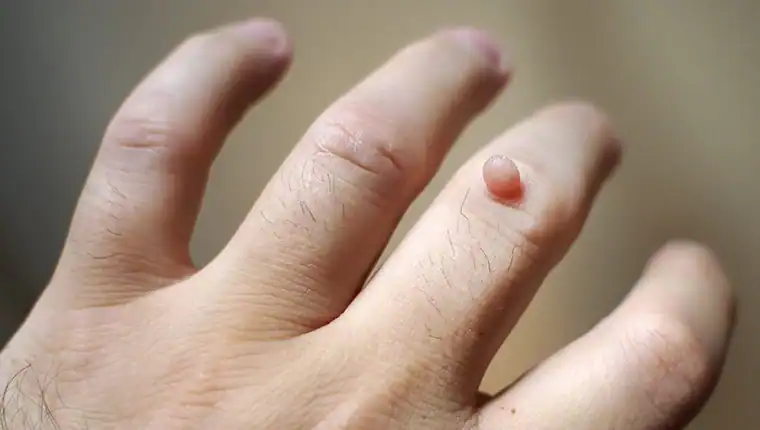 Cryotherapy For Warts And Also Verrucas 1 Image of blemish that Cryotherapy Matlock can remove with Lipo 360.