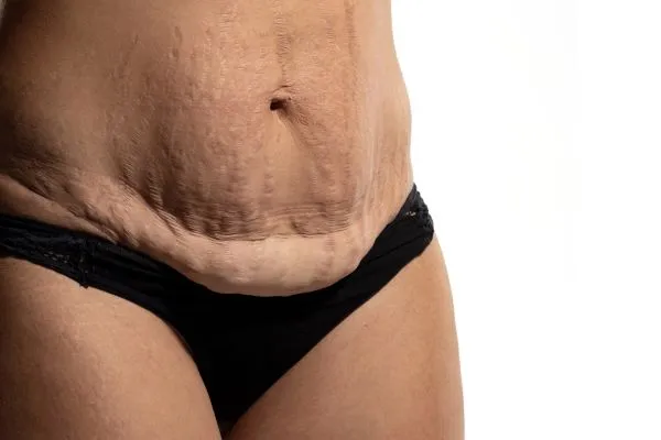 The Science of Skin Tightening 1 The science behind skin tightening Matlock picture of a woman's sagging skin on the stomach